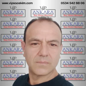 ankara saç ekimi